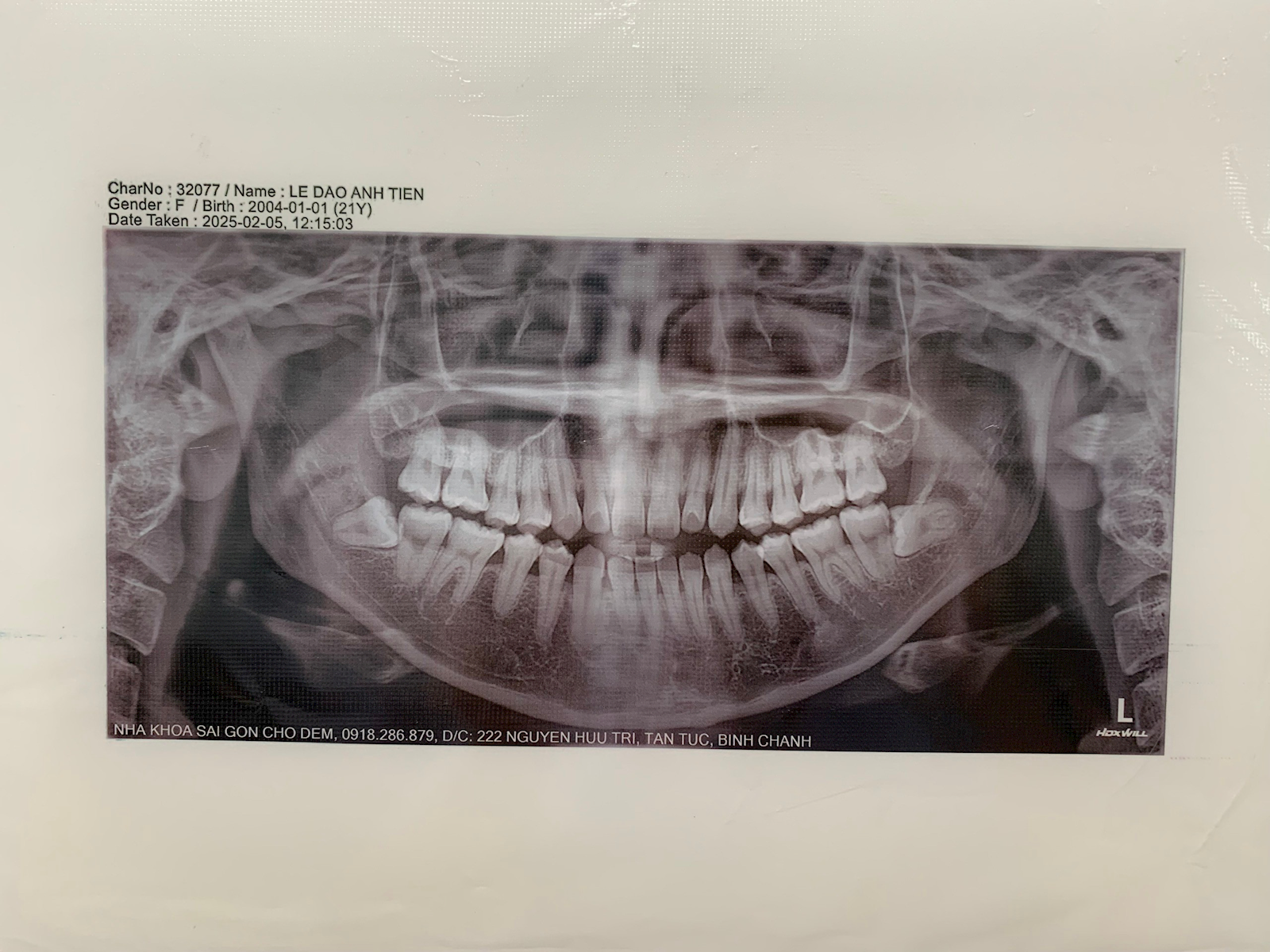 An x-ray of a person''s teeth

AI-generated content may be incorrect.