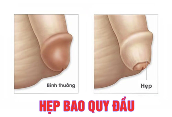 Description: Hẹp bao quy đầu có quan hệ được không? [BÁC SĨ TƯ VẤN]