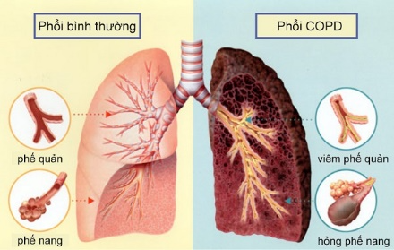 Description: A diagram of the lungs and the lungs

AI-generated content may be incorrect.