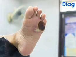 Description: A foot with a blister on it

AI-generated content may be incorrect.