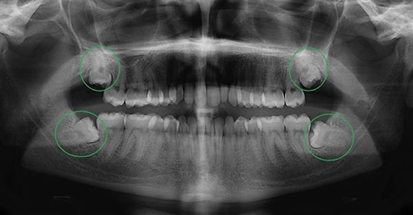 X-ray of a person''s teeth

AI-generated content may be incorrect.